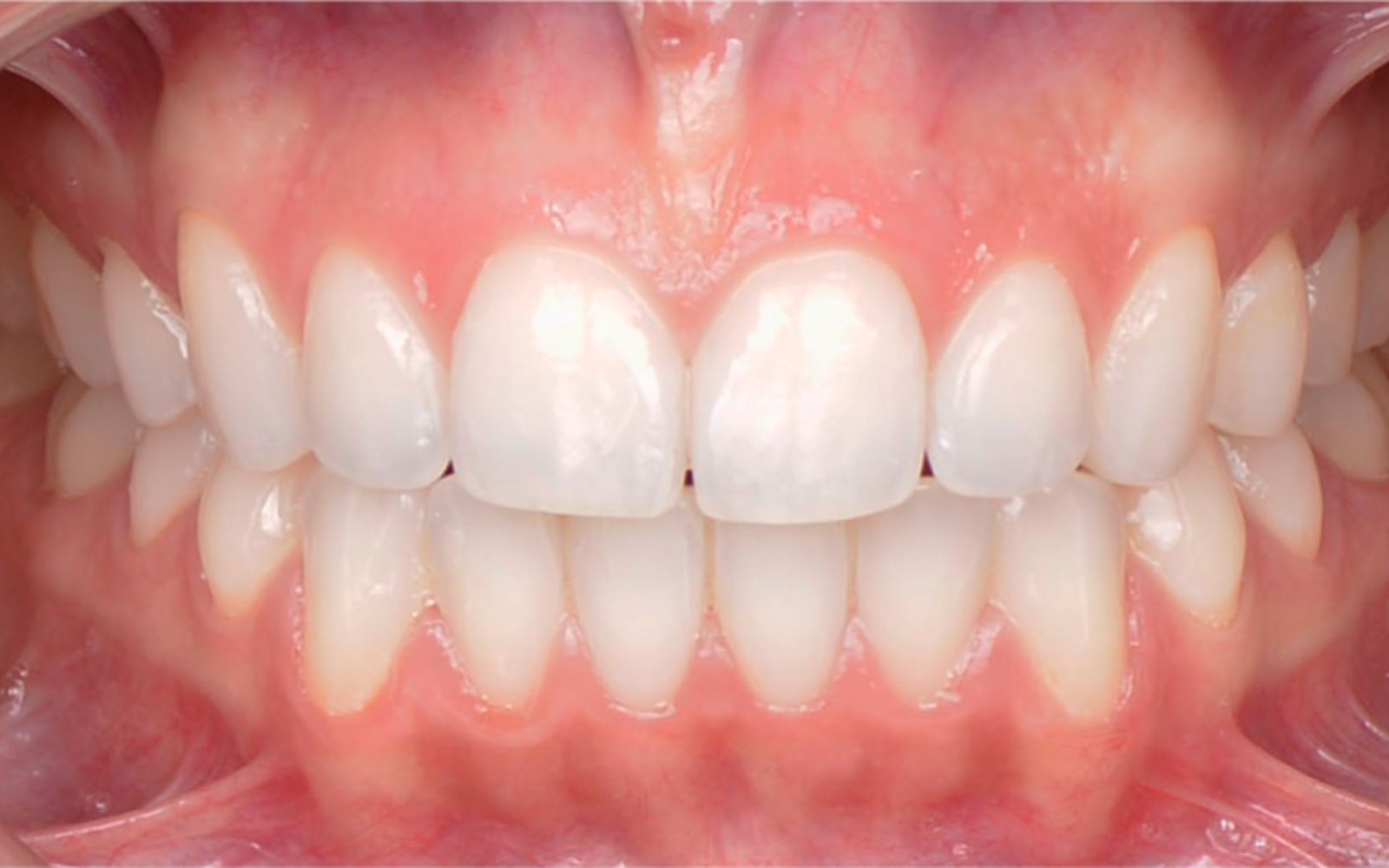 imagen laser3